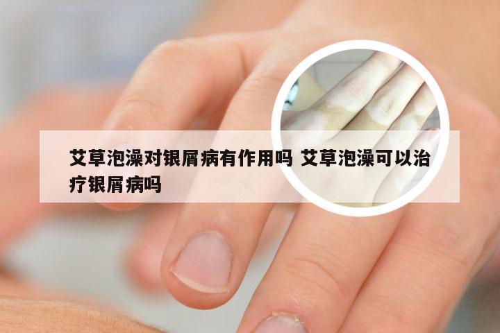 艾草泡澡对银屑病有作用吗 艾草泡澡可以治疗银屑病吗