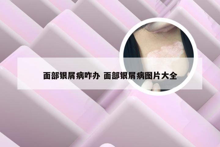 面部银屑病咋办 面部银屑病图片大全