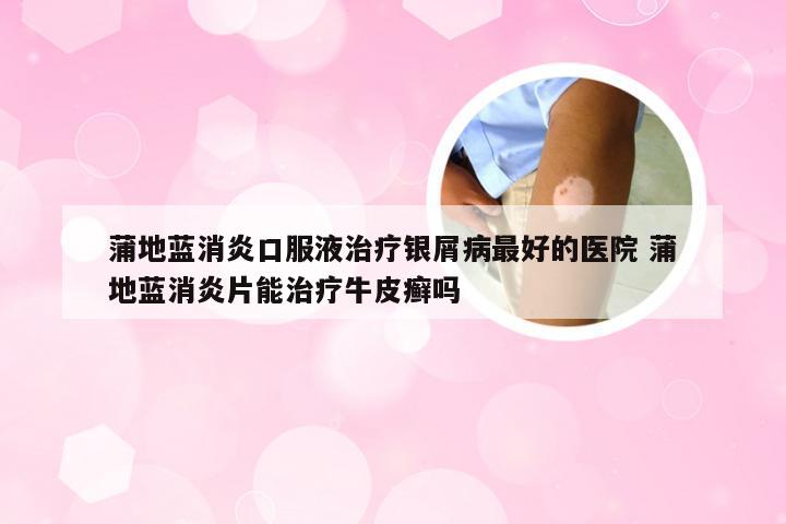 蒲地蓝消炎口服液治疗银屑病最好的医院 蒲地蓝消炎片能治疗牛皮癣吗