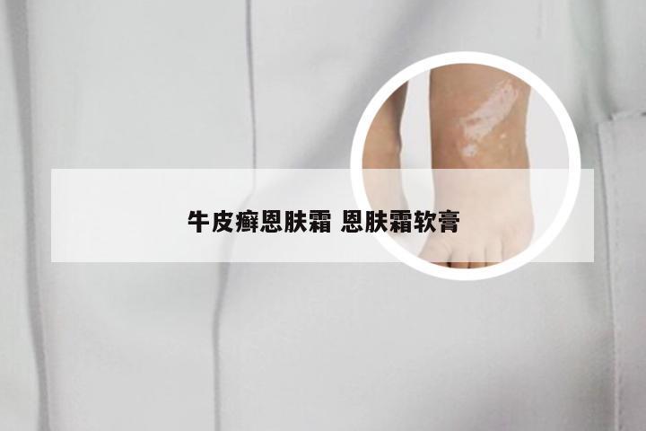 牛皮癣恩肤霜 恩肤霜软膏