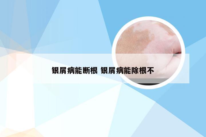 银屑病能断根 银屑病能除根不