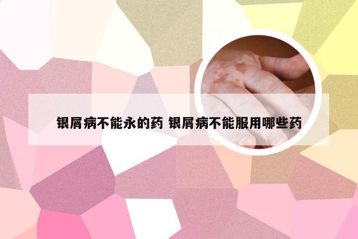 银屑病不能永的药 银屑病不能服用哪些药