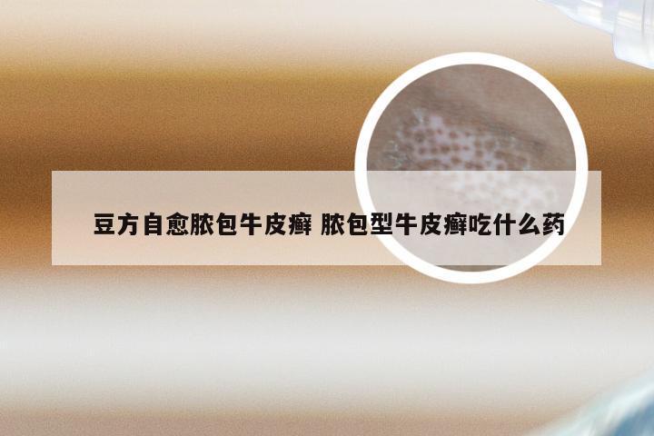 豆方自愈脓包牛皮癣 脓包型牛皮癣吃什么药
