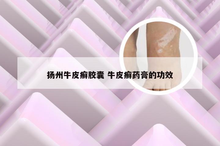 扬州牛皮癣胶囊 牛皮癣药膏的功效