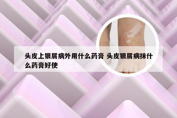 头皮上银屑病外用什么药膏 头皮银屑病抹什么药膏好使
