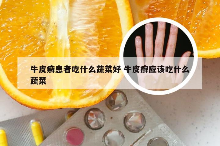 牛皮癣患者吃什么蔬菜好 牛皮癣应该吃什么蔬菜