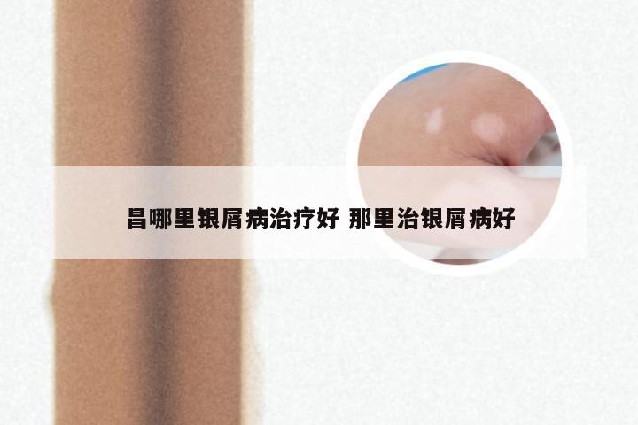 昌哪里银屑病治疗好 那里治银屑病好