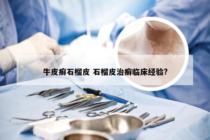 牛皮癣石榴皮 石榴皮治癣临床经验?