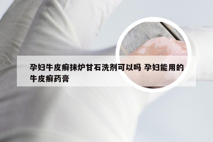 孕妇牛皮癣抹炉甘石洗剂可以吗 孕妇能用的牛皮癣药膏