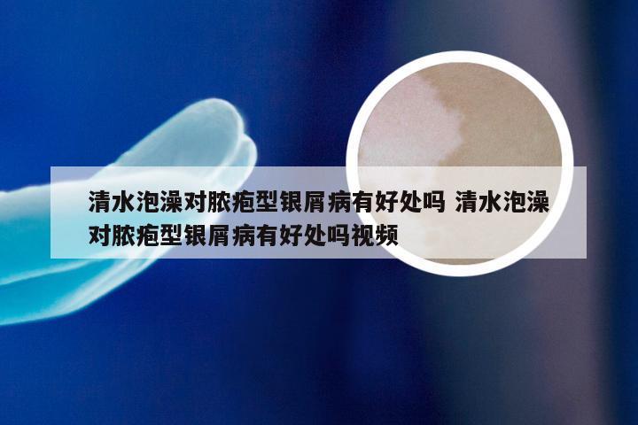 清水泡澡对脓疱型银屑病有好处吗 清水泡澡对脓疱型银屑病有好处吗视频