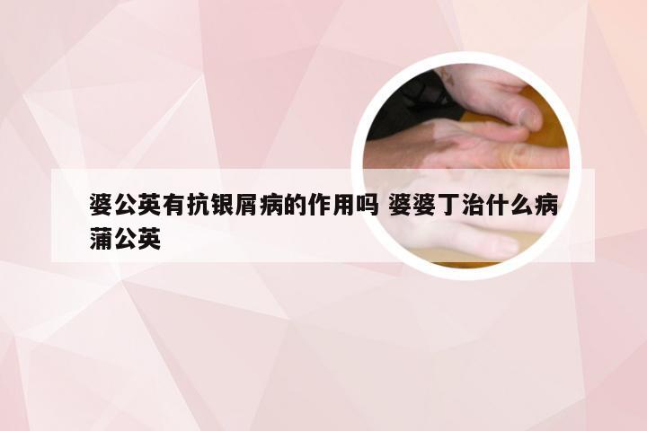 婆公英有抗银屑病的作用吗 婆婆丁治什么病蒲公英