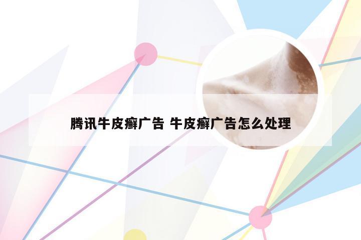 腾讯牛皮癣广告 牛皮癣广告怎么处理