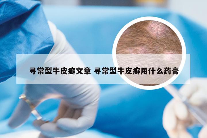 寻常型牛皮癣文章 寻常型牛皮癣用什么药膏