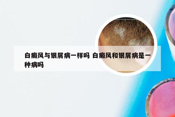白癜风与银屑病一样吗 白癜风和银屑病是一种病吗