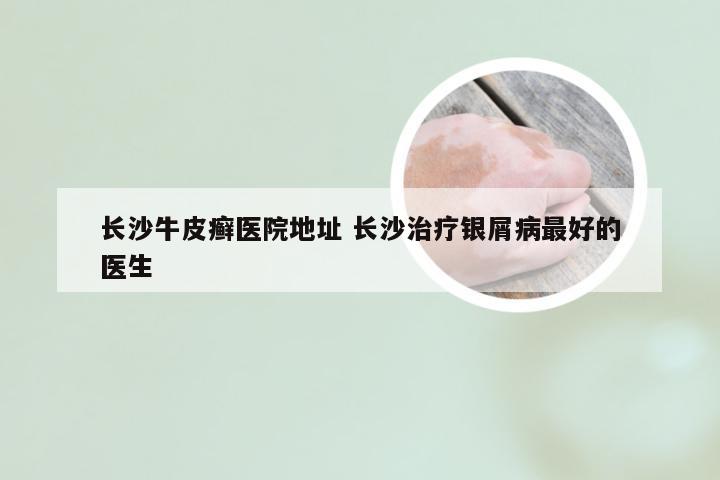 长沙牛皮癣医院地址 长沙治疗银屑病最好的医生