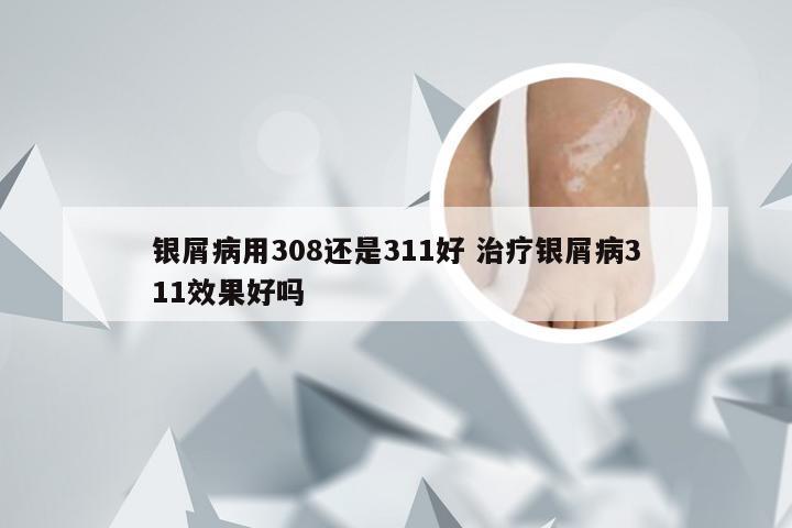 银屑病用308还是311好 治疗银屑病311效果好吗