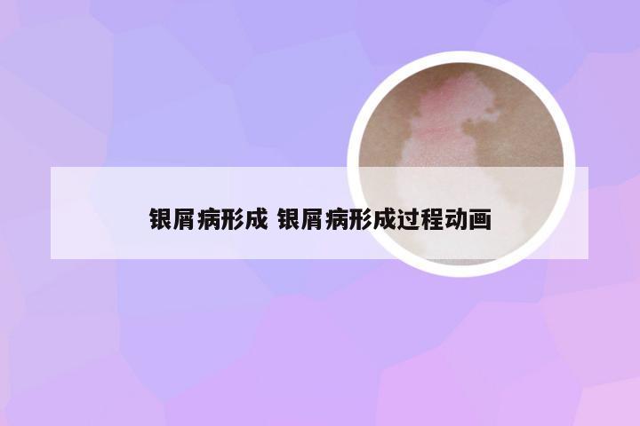 银屑病形成 银屑病形成过程动画