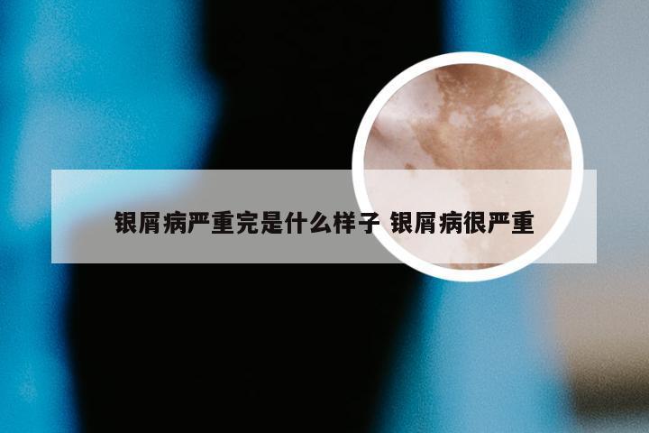 银屑病严重完是什么样子 银屑病很严重