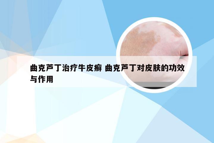 曲克芦丁治疗牛皮癣 曲克芦丁对皮肤的功效与作用