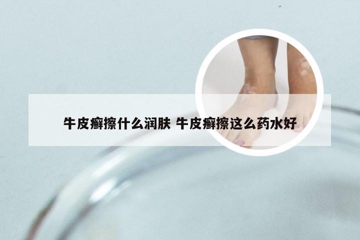 牛皮癣擦什么润肤 牛皮癣擦这么药水好