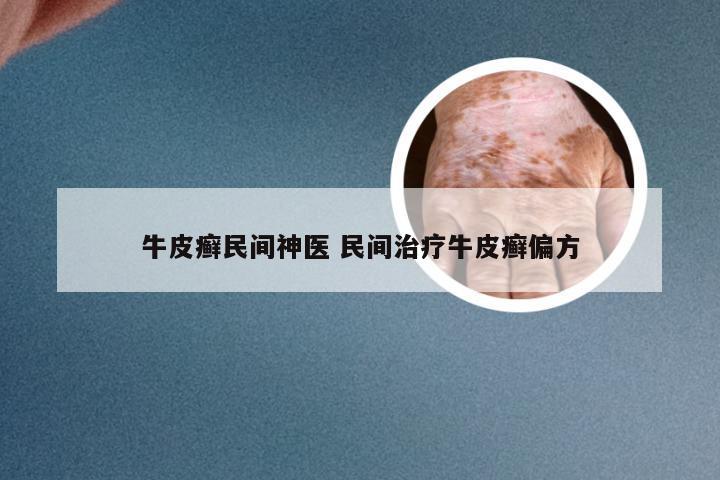 牛皮癣民间神医 民间治疗牛皮癣偏方