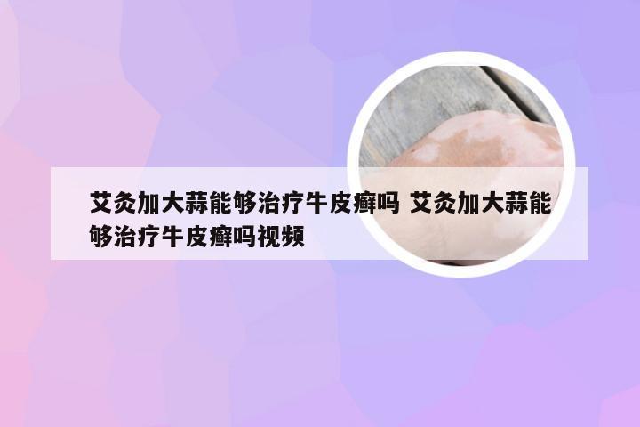 艾灸加大蒜能够治疗牛皮癣吗 艾灸加大蒜能够治疗牛皮癣吗视频