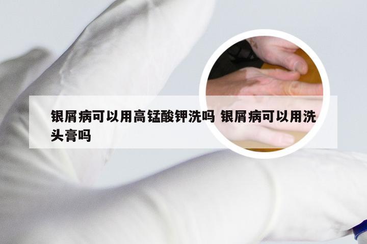 银屑病可以用高锰酸钾洗吗 银屑病可以用洗头膏吗