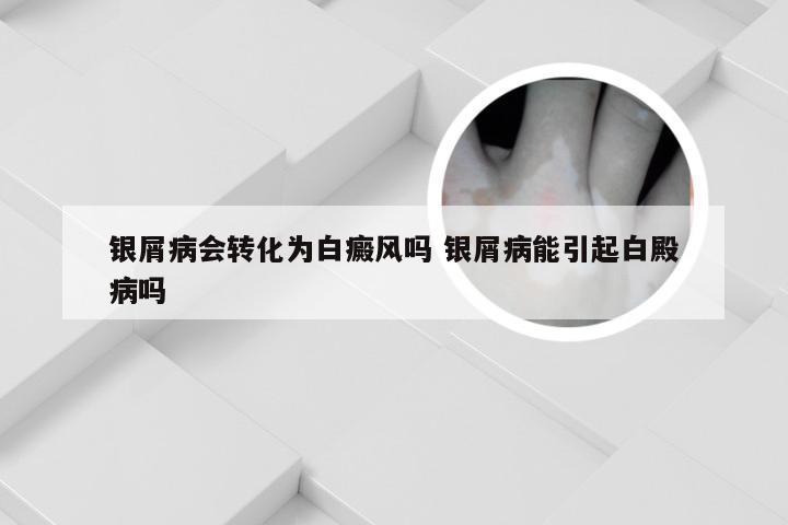 银屑病会转化为白癜风吗 银屑病能引起白殿病吗