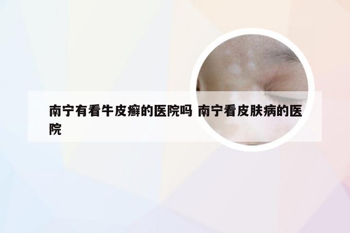 南宁有看牛皮癣的医院吗 南宁看皮肤病的医院