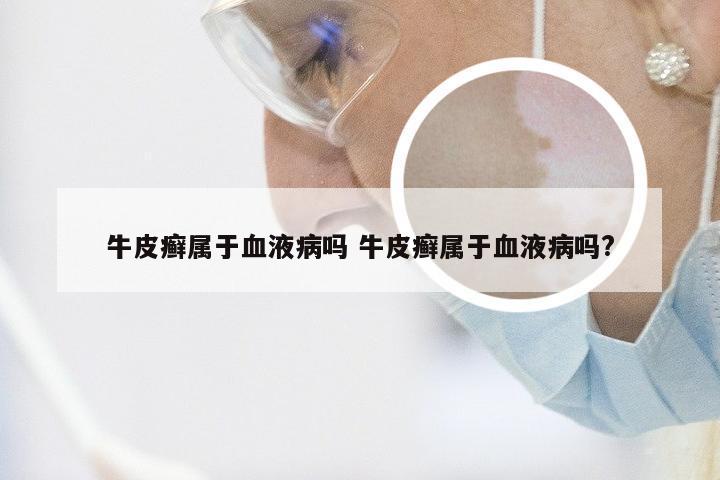 牛皮癣属于血液病吗 牛皮癣属于血液病吗?