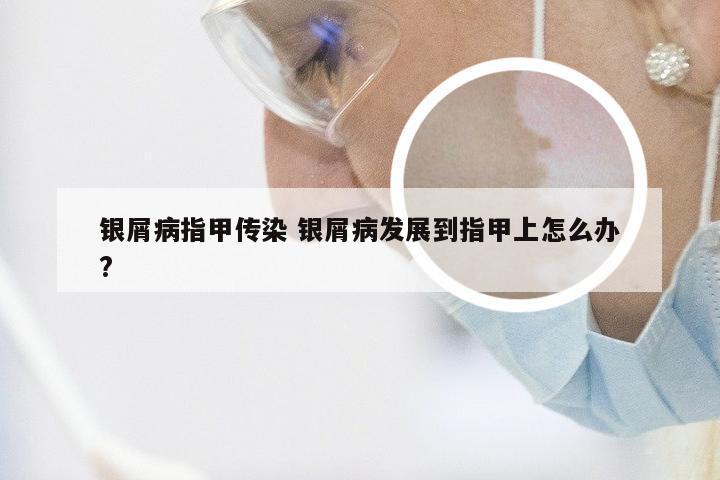 银屑病指甲传染 银屑病发展到指甲上怎么办?