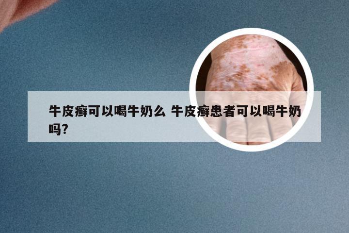 牛皮癣可以喝牛奶么 牛皮癣患者可以喝牛奶吗?