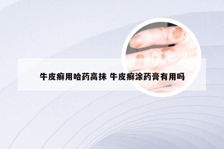 牛皮癣用哈药高抹 牛皮癣涂药膏有用吗