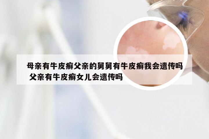 母亲有牛皮癣父亲的舅舅有牛皮癣我会遗传吗 父亲有牛皮癣女儿会遗传吗