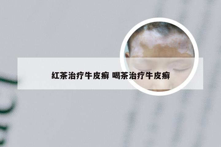 红茶治疗牛皮癣 喝茶治疗牛皮癣
