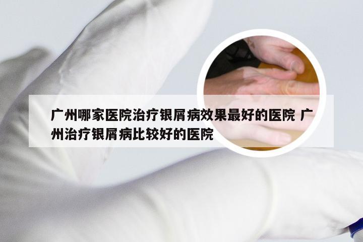 广州哪家医院治疗银屑病效果最好的医院 广州治疗银屑病比较好的医院