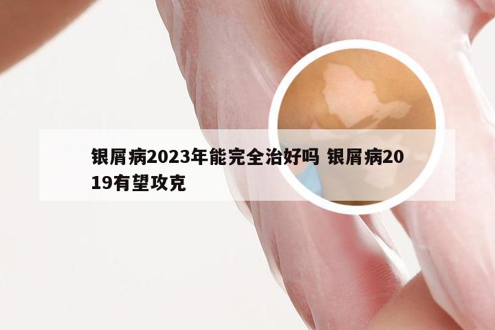 银屑病2023年能完全治好吗 银屑病2019有望攻克