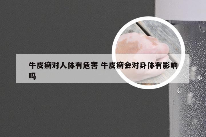 牛皮癣对人体有危害 牛皮癣会对身体有影响吗