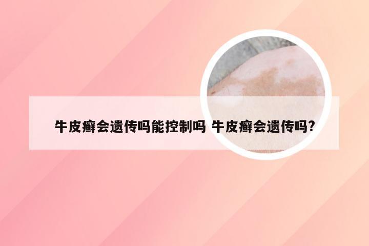牛皮癣会遗传吗能控制吗 牛皮癣会遗传吗?