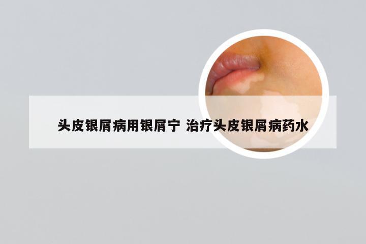 头皮银屑病用银屑宁 治疗头皮银屑病药水