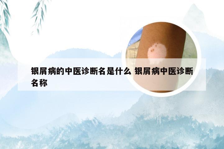 银屑病的中医诊断名是什么 银屑病中医诊断名称