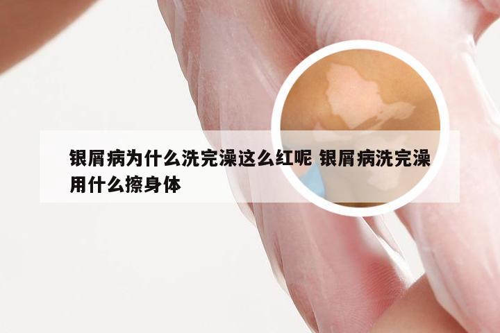 银屑病为什么洗完澡这么红呢 银屑病洗完澡用什么擦身体