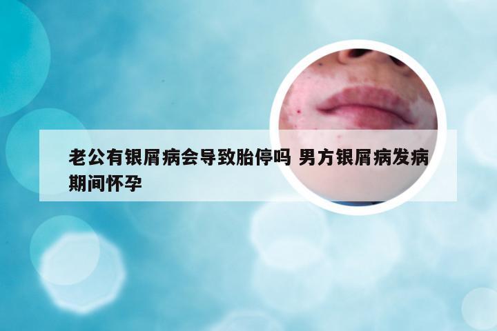 老公有银屑病会导致胎停吗 男方银屑病发病期间怀孕