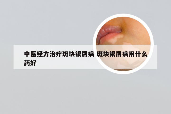 中医经方治疗斑块银屑病 斑块银屑病用什么药好