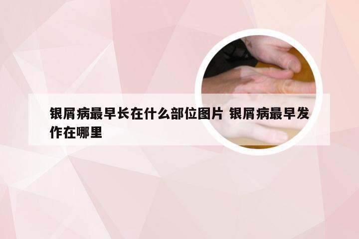银屑病最早长在什么部位图片 银屑病最早发作在哪里