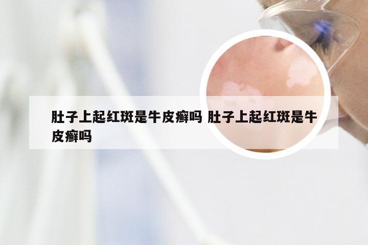肚子上起红斑是牛皮癣吗 肚子上起红斑是牛皮癣吗