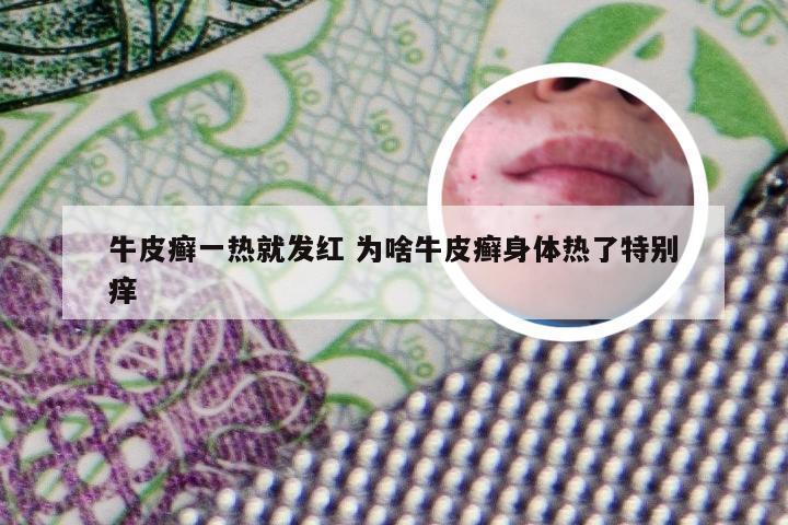 牛皮癣一热就发红 为啥牛皮癣身体热了特别痒