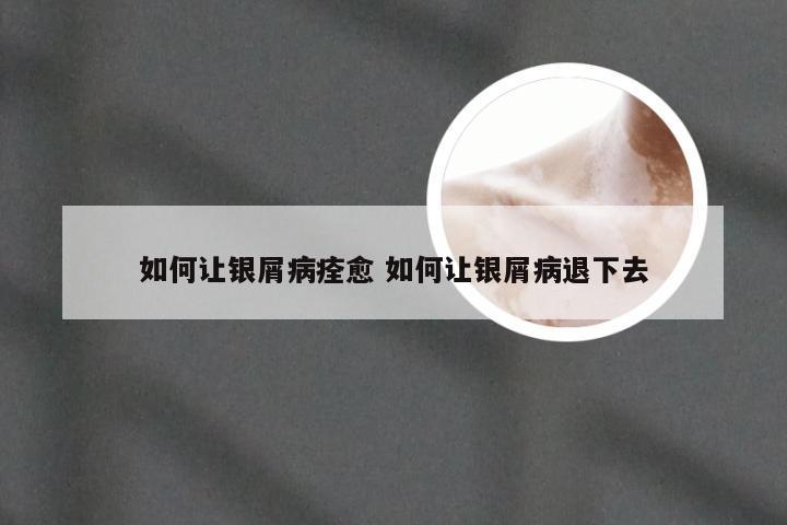 如何让银屑病痊愈 如何让银屑病退下去