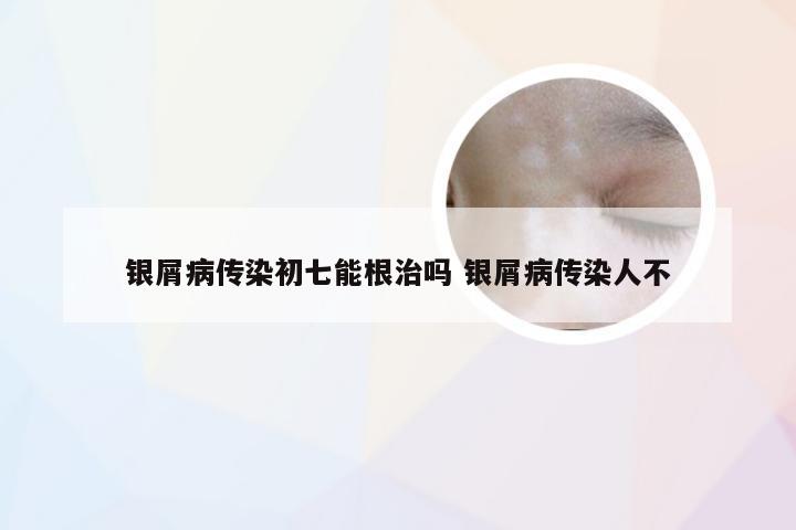 银屑病传染初七能根治吗 银屑病传染人不