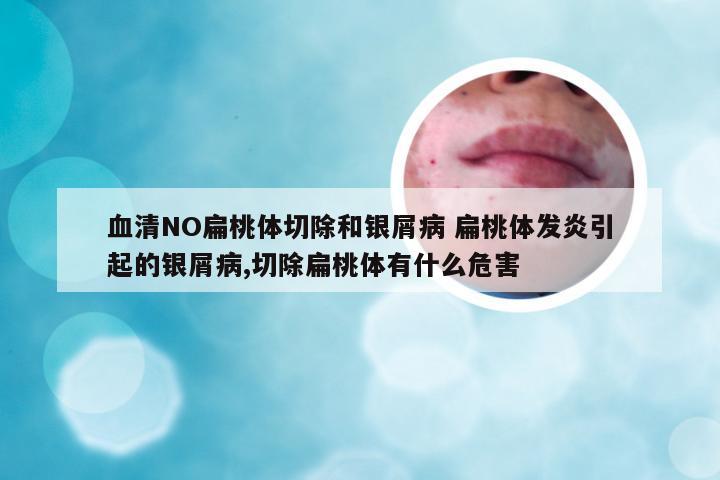 血清NO扁桃体切除和银屑病 扁桃体发炎引起的银屑病,切除扁桃体有什么危害